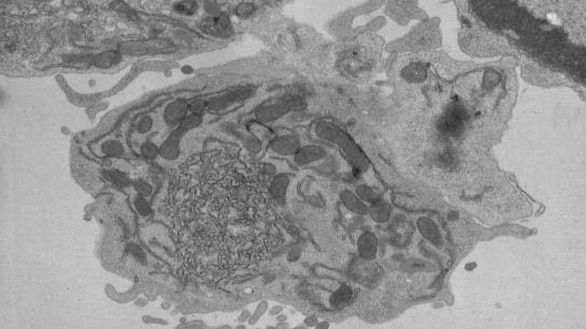 A conventional type 1 dendritic cell with IRE1 knocked out. The 'tangled ribbons' are the malformed endoplasmic reticulum, probably due to excess cholesterol. (@Victor Bosteels, Sophie Janssens, VIB) A conventional type 1 dendritic cell with IRE1 knocked out. The 'tangled ribbons' are the malformed endoplasmic reticulum, probably due to excess cholesterol. (@Victor Bosteels, Sophie Janssens, VIB)